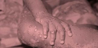 Novica: Pozor Virus opičjih koz v Sloveniji opičje koze virus